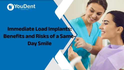 Immediate Load Implants: Benefits and Risks of a Same-Day Smile