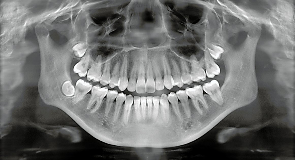 Dental X-Ray Market