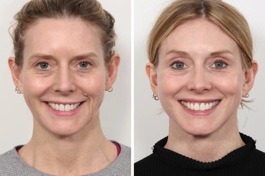 Best Aesthetic Clinics in Dubai for Thread Lift and Skin Tightening Solutions