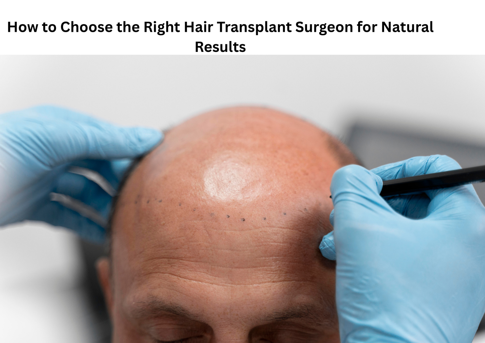 How to Choose the Right Hair Transplant Surgeon for Natural Results