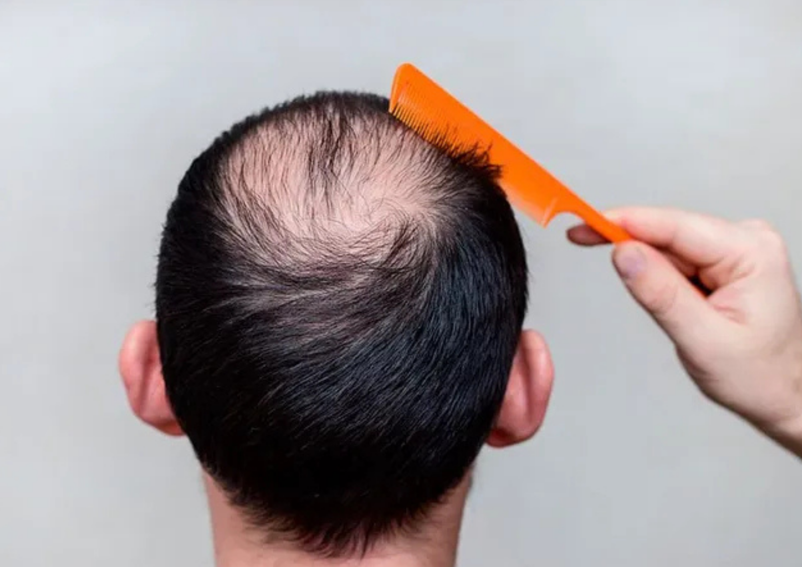 What You Can Learn from Celebrity Hair Restoration Journeys