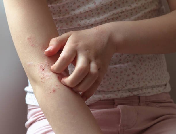 eczema creams