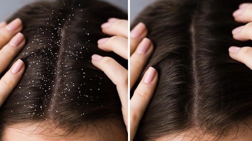 anti dandruff treatment in Ghatkopar